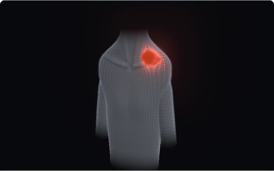 Grafik zum Typ Herniierter Triggerpunkt